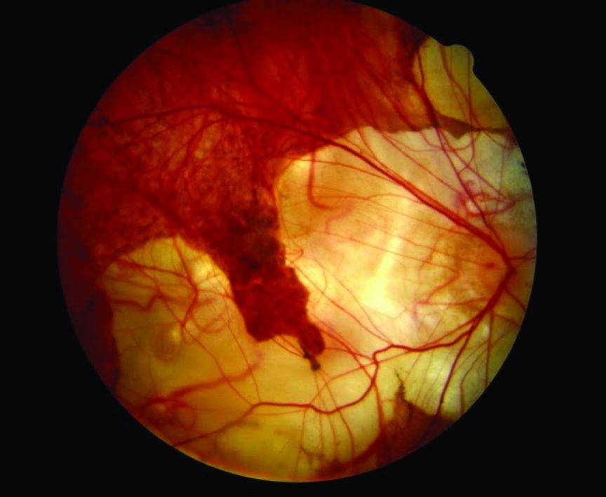 Миопическая дегенерация. миопический конус и стафилома — причины и лечение глазное дно миопический конус