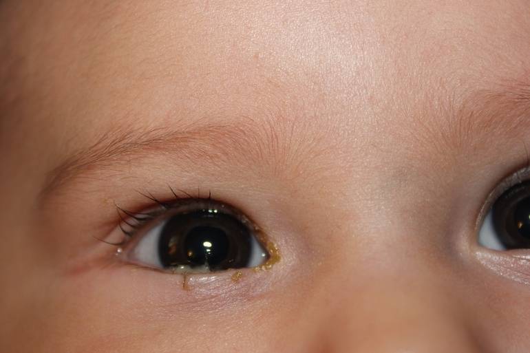 Ребенок температура слезятся глаза. Дакриоцистит осложнения конъюнктивит. Дакриоцистит новорожденных дакриоцистит. Дакриоцистит новорожденных слезостояние. Конъюнктивит и дакриоцистит новорожденных.