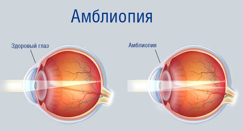 Здоровье глаз призывников – заболевания, с которыми не берут в армию