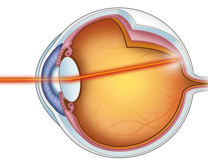Ожог сетчатки глаза сваркой или кварцевой лампой - признаки повреждения, первая помощь для зрения и средства для лечения
