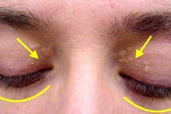 Жировик на веке глаз (верхнем и нижнем): почему появился, как избавиться и убрать быстро, лечение, профилактика