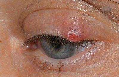 Лечение халязиона века в домашних условиях - "здоровое око"