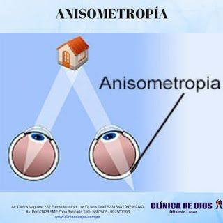 Что такое анизометропия: причины, проявления и виды коррекции