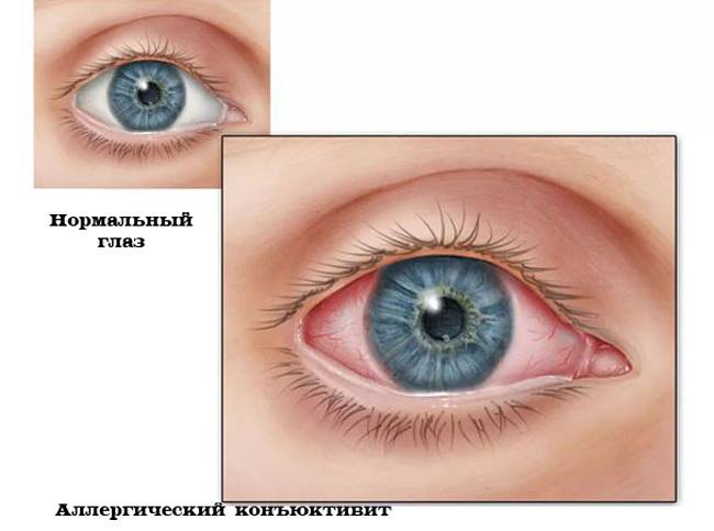 Конъюнктивит: причины, лечение, профилактика - "здоровое око"