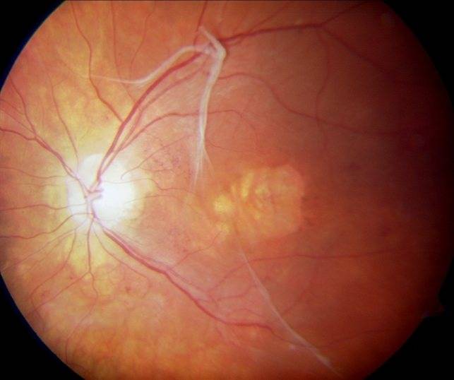 Эпиретинальная мембрана глаза: лечение, как делается операция | мрикрнц.рф