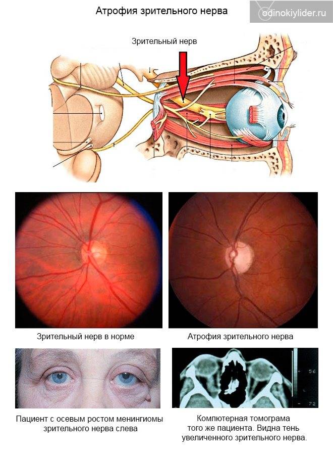 Атрофия зрительного нерва: лечение и симптомы, полная и частичная, народные средства