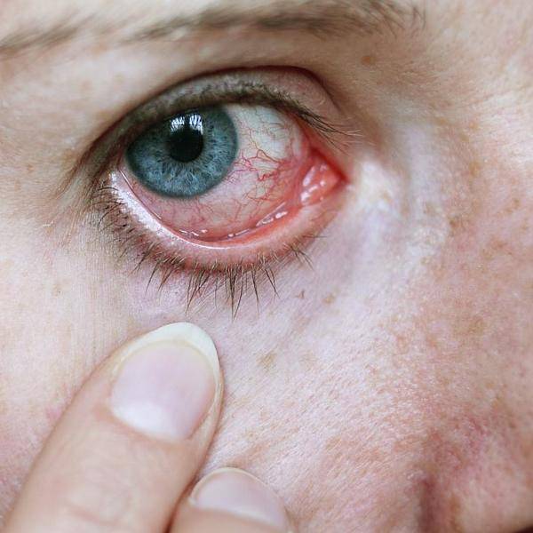 Офтальмогерпес и герпетический кератит: причины возникновения глазного герпеса, симптомы, диагностика и лечение + фото
