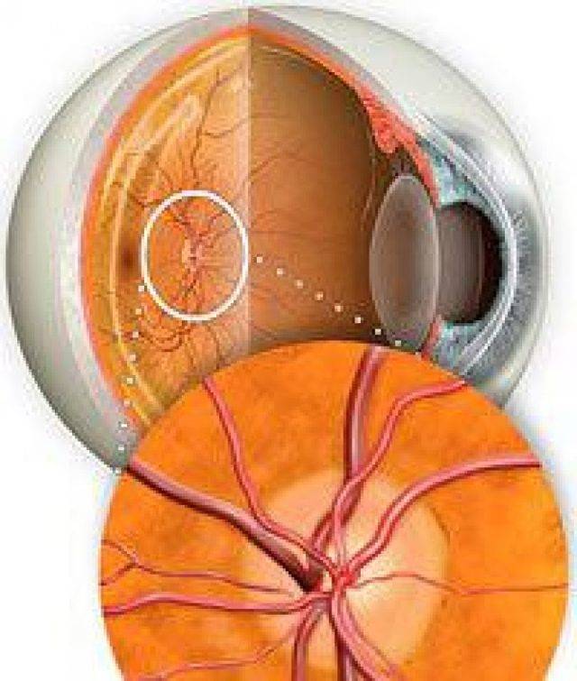 Неврит зрительного нерва: причины, симптомы, лечение