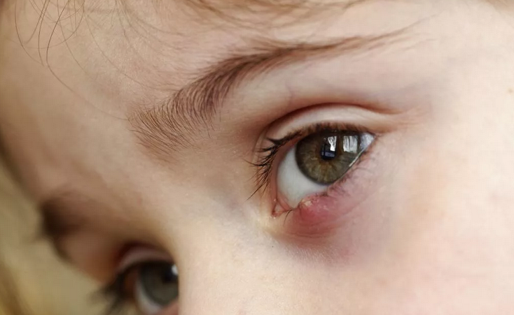 Воспаление глаза у ребёнка