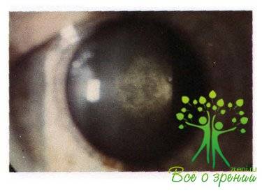 Лечение фиброза задней капсулы хрусталика глаза