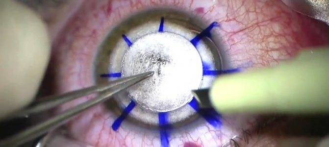 Помутнение роговицы глаза: лечение хирургическим путем, медикаментозными и народными средствами