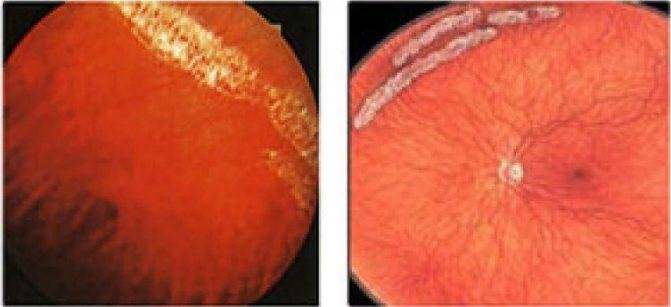 Ангиосклероз сетчатки глаза, что это такое: основные причины заболевания