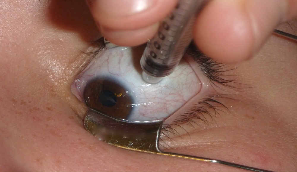 Инъекции в глаза при глаукоме