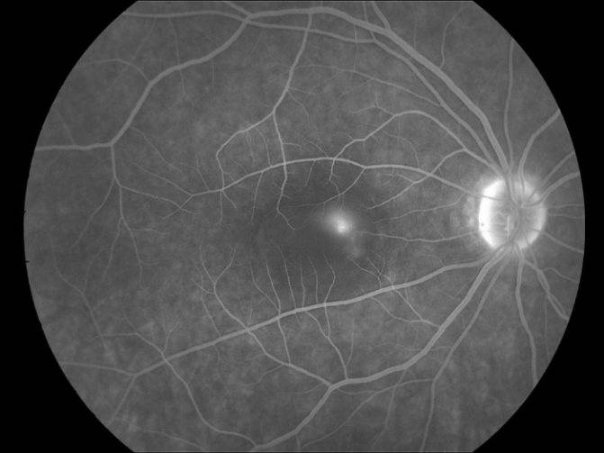 Хориоретинит глаза: лечение, симптомы, диагностика, причины и осложнения
