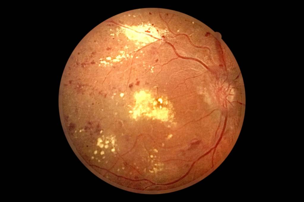 Фоновая ретинопатия и ретинальные сосудистые изменения