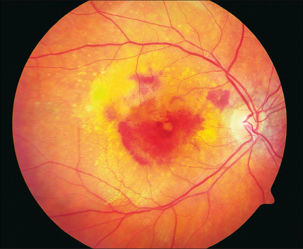 Заболевания сетчатки глаза: виды и способы лечения - "здоровое око"