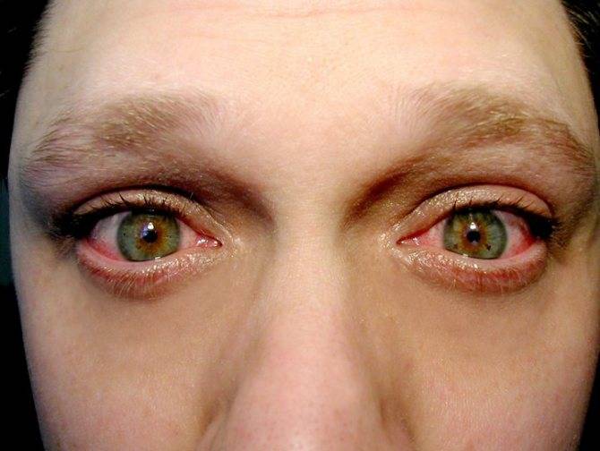 Блефарит глаз: фото, симптомы, лечение у взрослых и детей