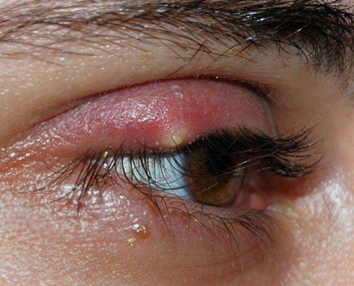 Что делать при появлении первых симптомов ячменя на глазу