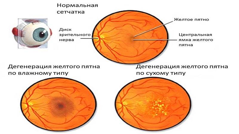 Макулодистрофия сетчатки глаза: что это такое и как лечить?