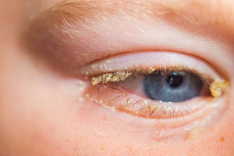 Гнойный конъюнктивит у детей: причины, лечение - "здоровое око"