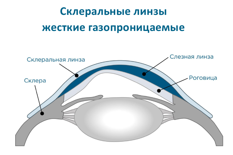 Жесткие контактные линзы для коррекции зрения: преимущества, как одевать и хранить твердые линзы