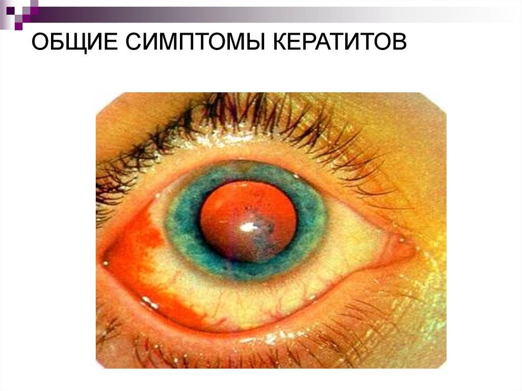 Кератит: симптомы, фото, лечение. чем лечить кератит глаза