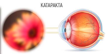 Может ли помутнеть современная интраокулярная линза — каков срок службы искусственного хрусталика глаза