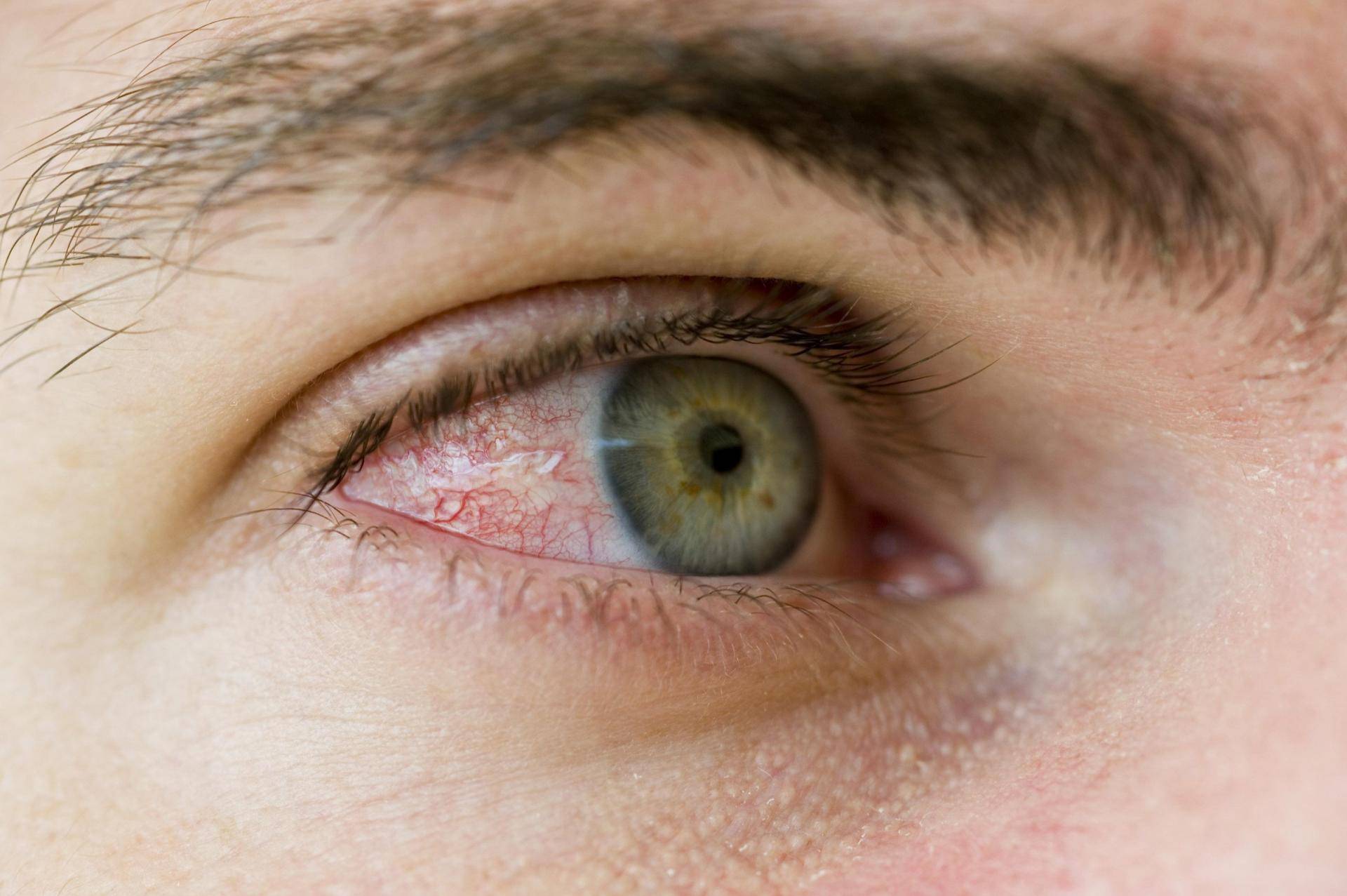 Распространенные инфекции глаз: вирусные, бактериальные, грибковые