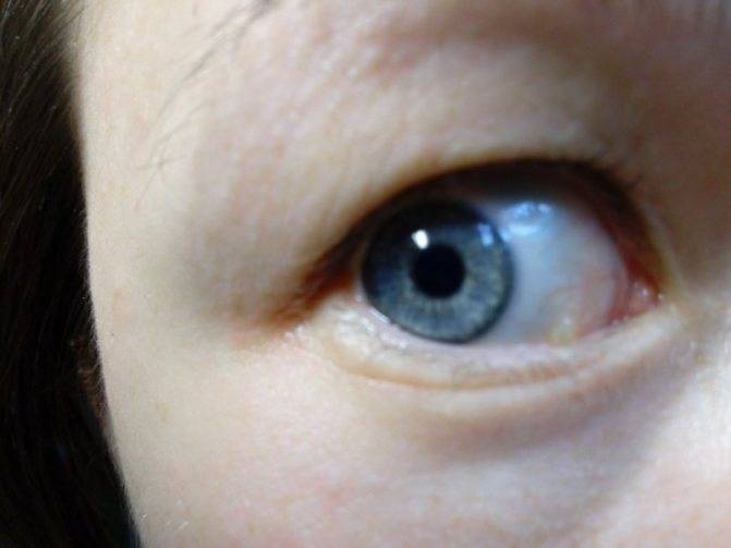 Киста глаза (конъюнктивы): причины, лечение и удаление