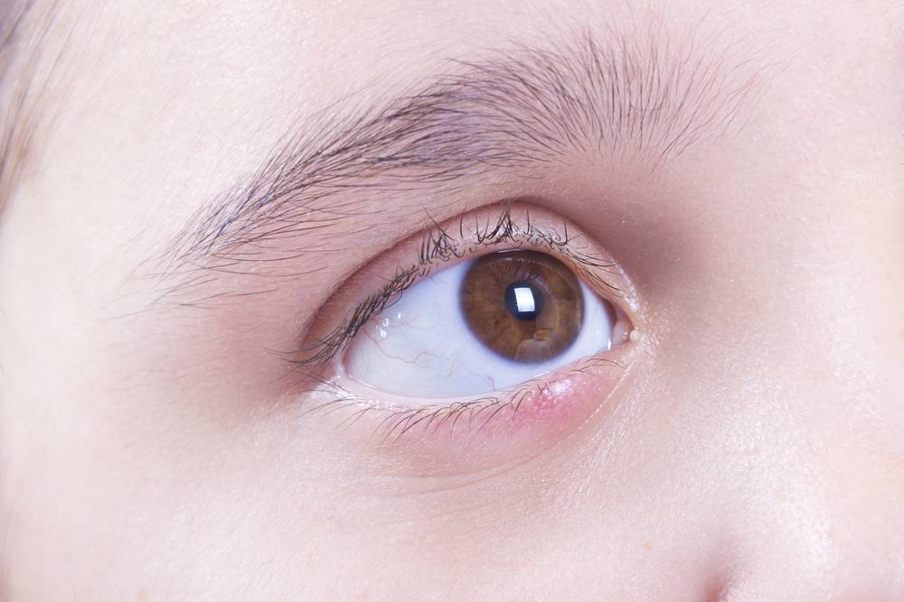 Как лечить ячмень на глазу у ребёнка в домашних условиях oculistic.ru
как лечить ячмень на глазу у ребёнка в домашних условиях