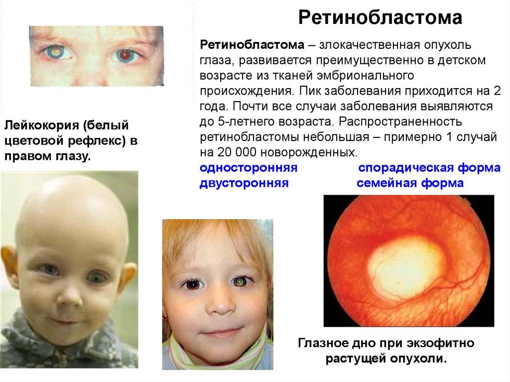 Рак сетчатки глаза у детей: симптомы, лечение, прогноз