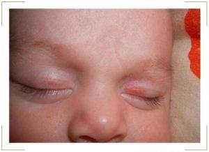 Кавернозная гемангиома на голове у ребенка : labuda.blog
кавернозная гемангиома на голове у ребенка — «лабуда» информационно-развлекательный интернет журнал