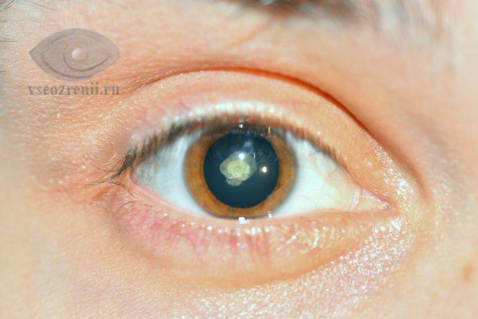 Что такое врожденная катаракта: причины и лечение