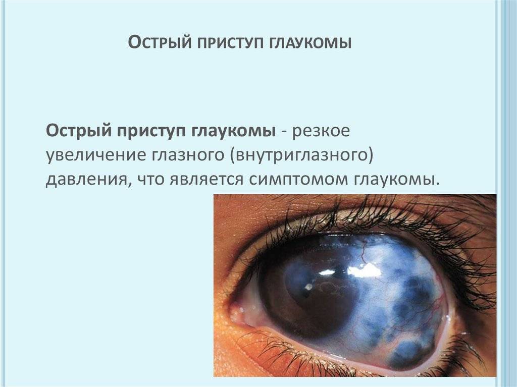 Первая помощь при приступе глаукомы - вылечимглаукому