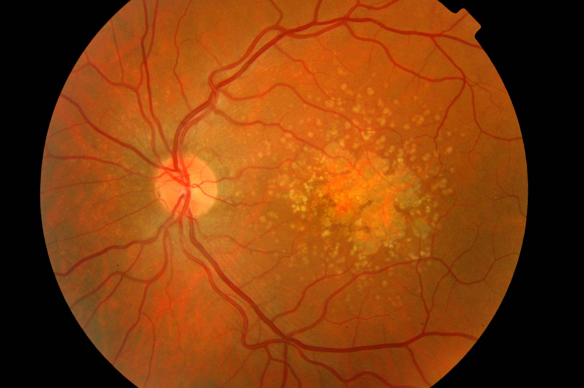 Причины абиотрофии сетчатки глаза у детей и взрослых – диагностика и лечение патологии