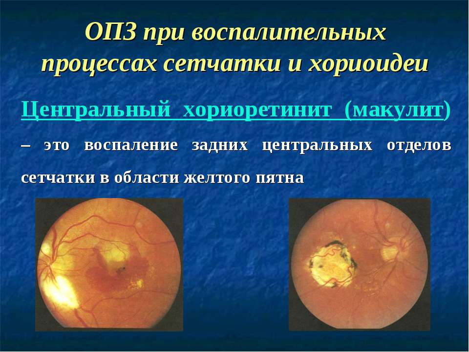 В чем опасность хориоретинита глаза, можно ли его вылечить и как?