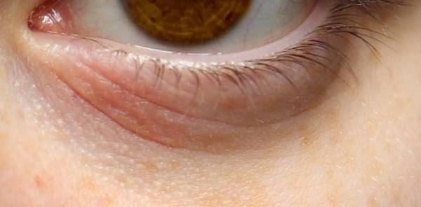 Шелушится кожа вокруг глаз — какими лекарствами лечить, причины