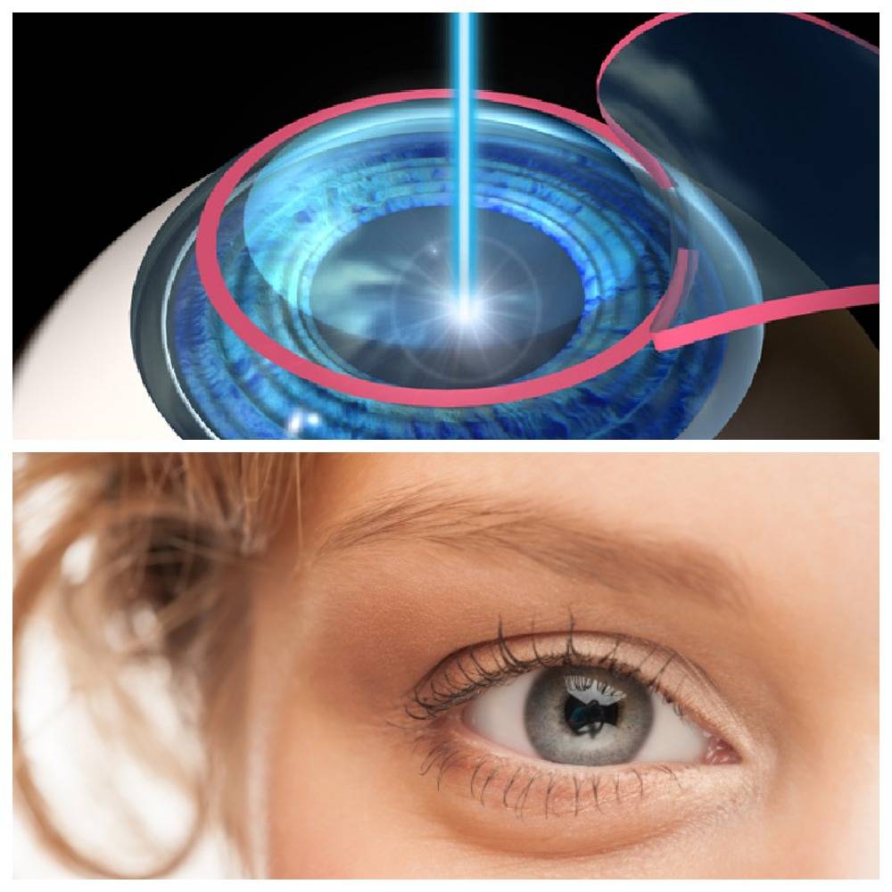 Лазерная коррекция зрения: плюсы и минусы, мнение специалистов, все за и против операции на глаза