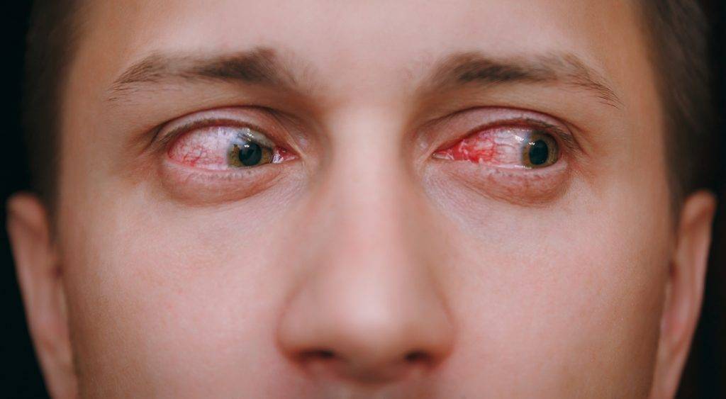 Ожог роговицы глаза – симптомы и лечение (фото). химический ожог.