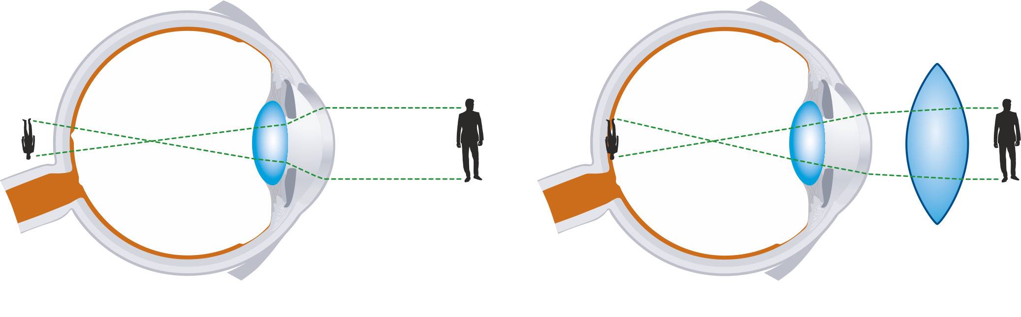 Близорукость изображение фокусируется