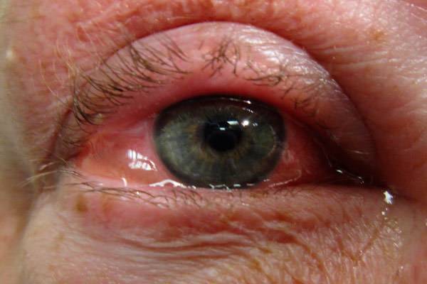 Рак глаза - симптомы и лечение