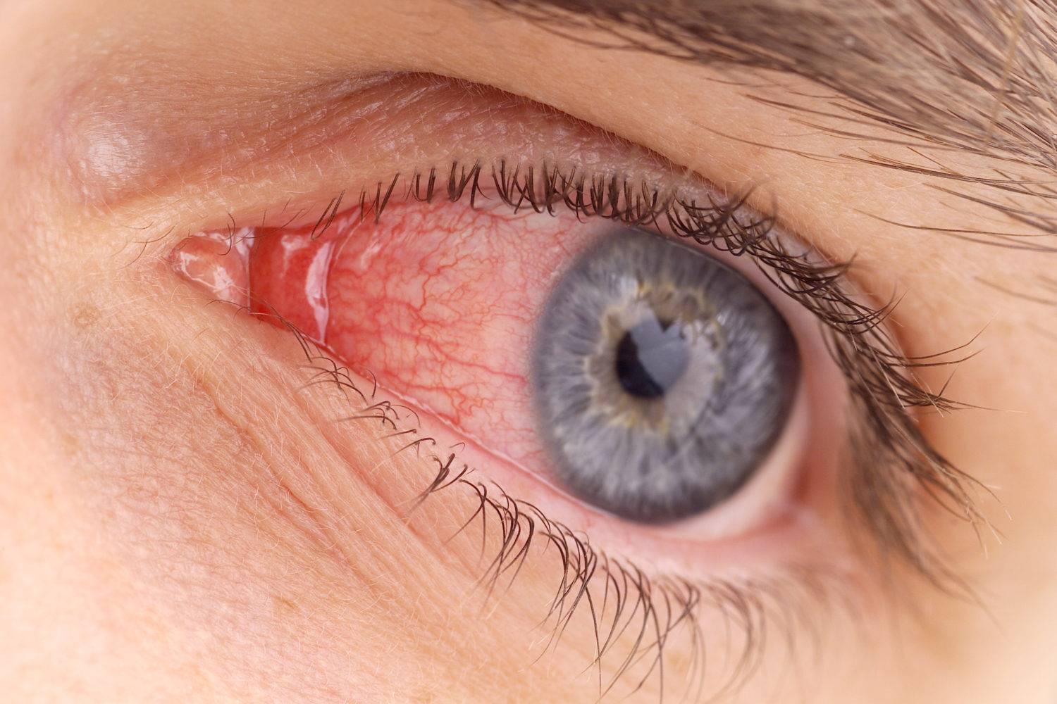 Как не допустить воспаления глаз: профилактика конъюнктивита