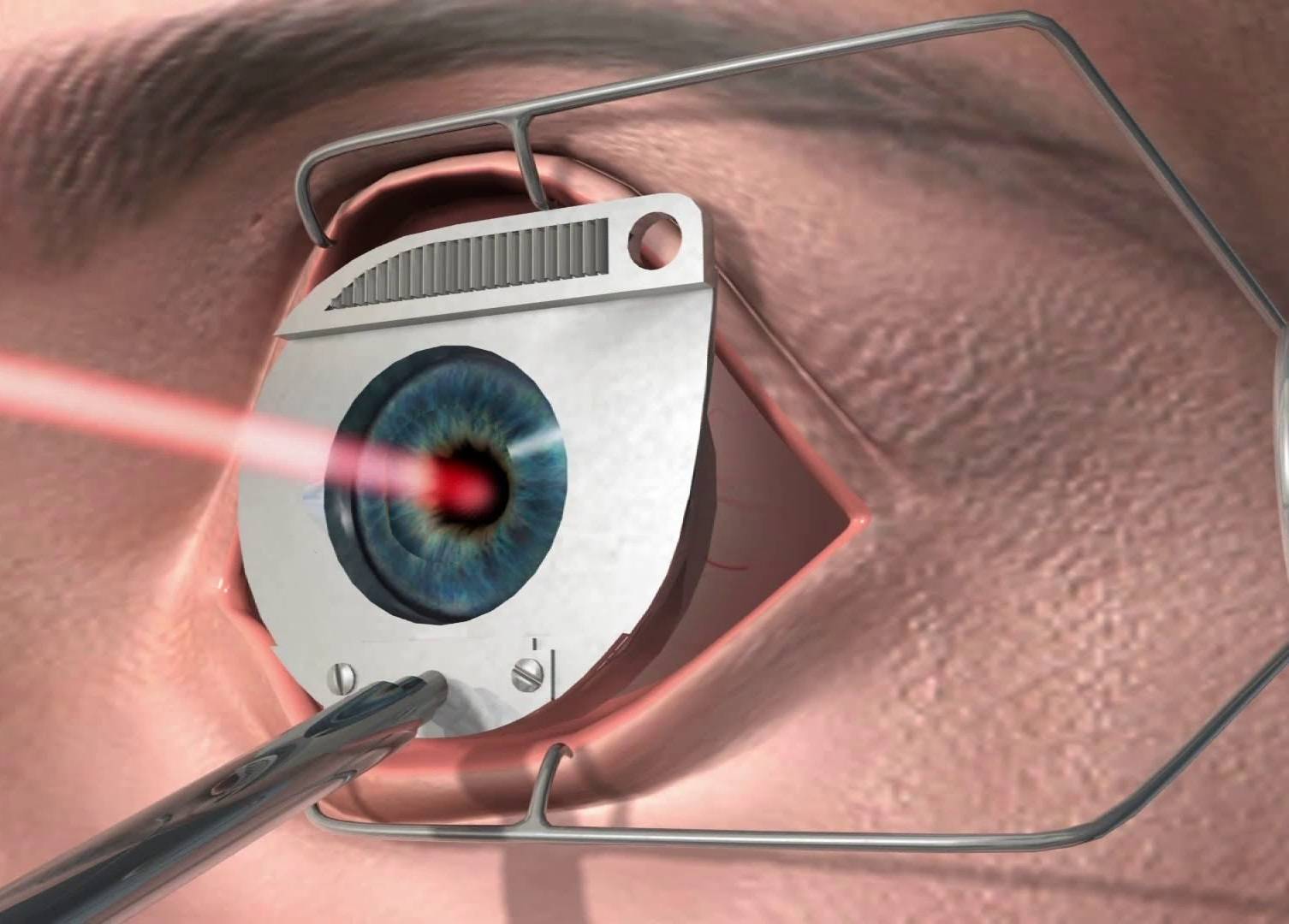 Можно ли повторно делать лазерную коррекцию зрения