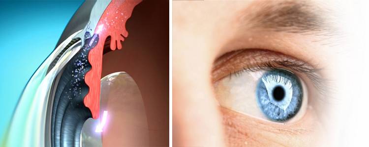 Открытоугольная глаукома: причины, симптомы, лечение и профилактика