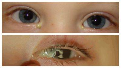 Бактериальный конъюнктивит у детей: причины, симптомы, лечение - "здоровое око"