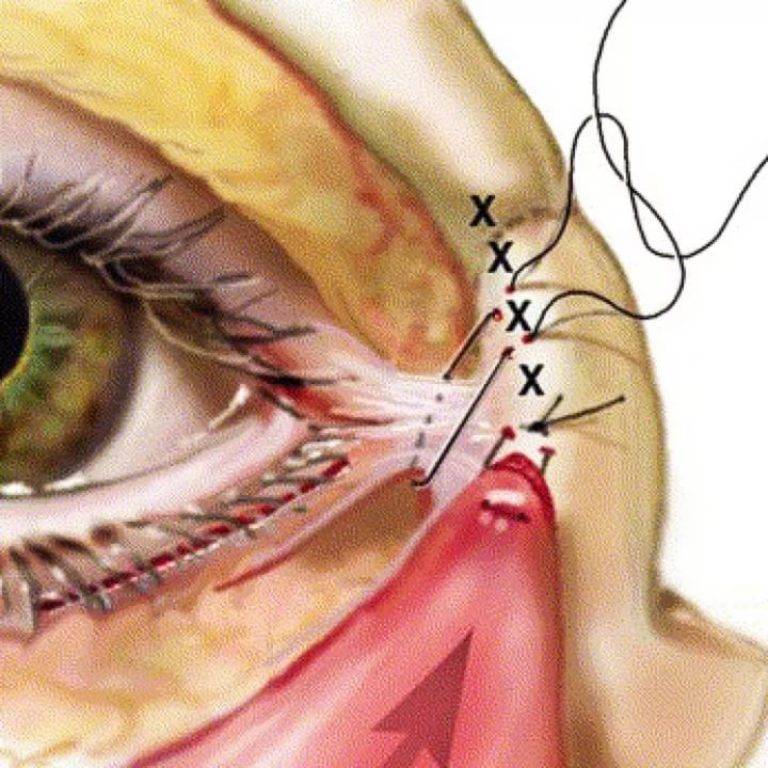 Укрепление склеры глаза