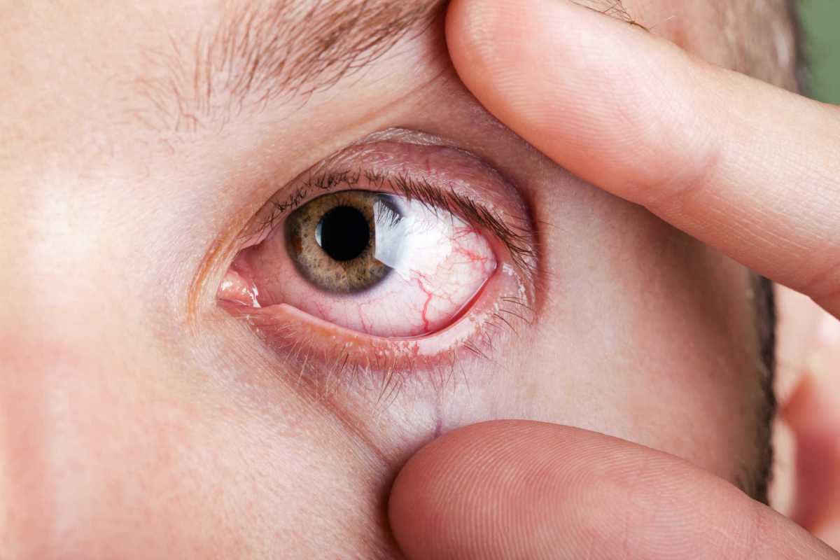Грибковые заболевания глаз фото лечение симптомы причины - мед портал tvoiamedkarta.ru