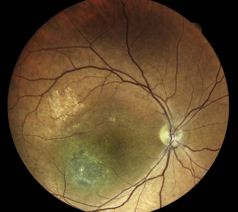 Лечение ретиношизиса в москве