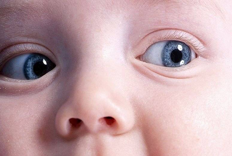 Нистагм глаз у детей: что это такое, причины и лечение