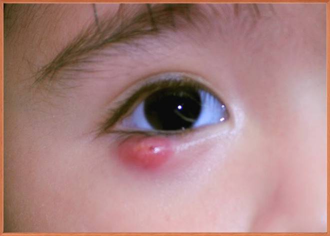 Е. комаровский: как лечить ячмень на глазу у ребенка: чем лечить, что делать